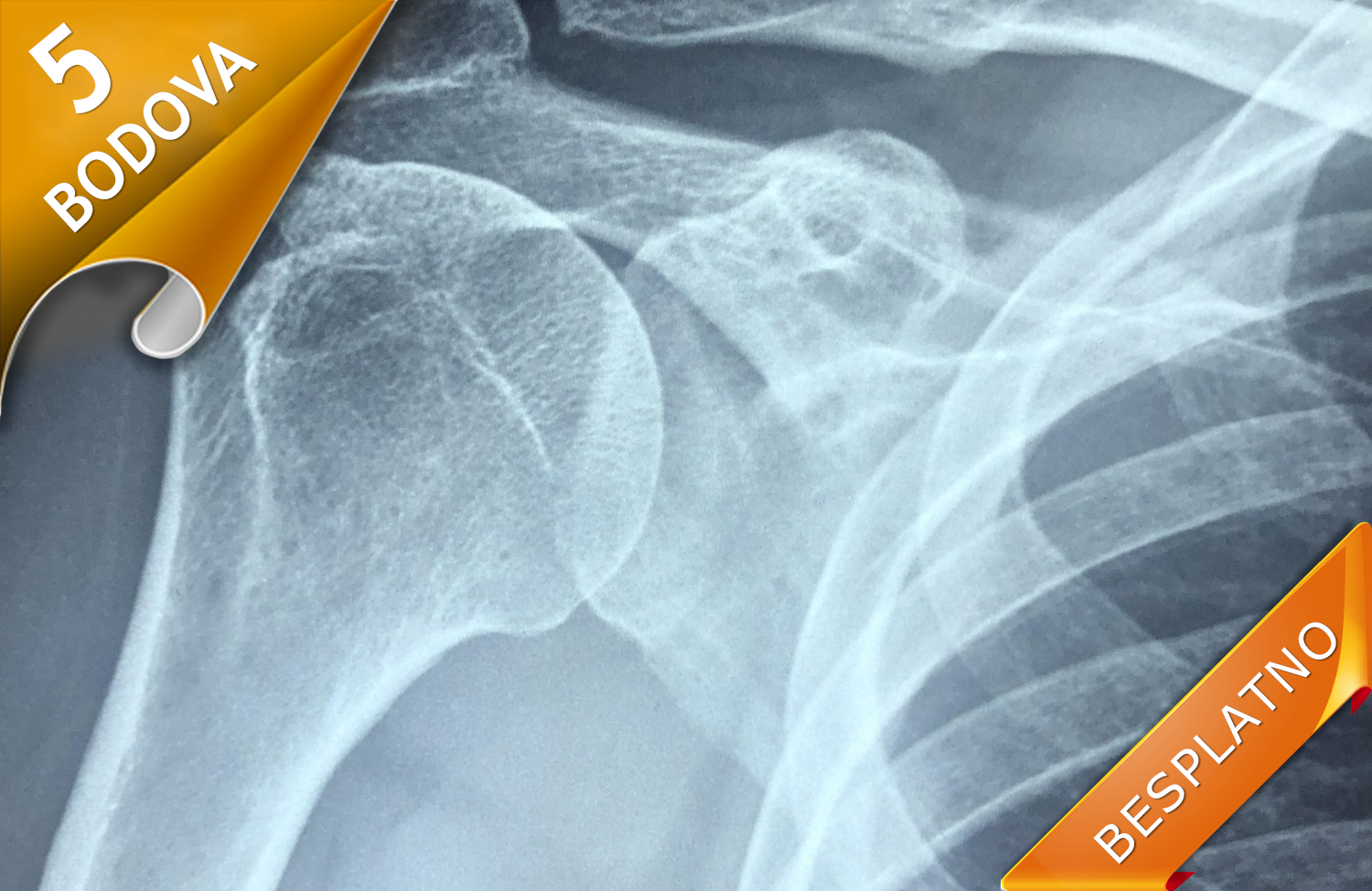 METABOLIČKE BOLESTI KOSTIJU KOD ODRASLIH